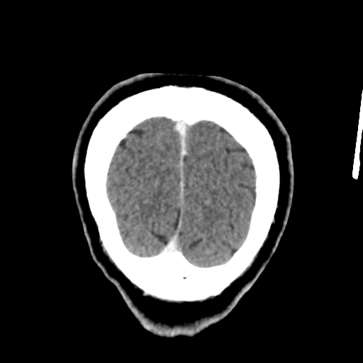 File:Atypical meningioma (WHO grade II) with osseous invasion (Radiopaedia 53654-59715 Coronal C+ delayed 56).png