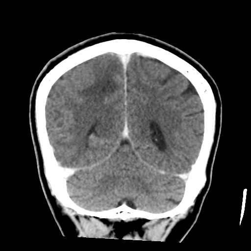 Atypical meningioma with skull invasion (Radiopaedia 34357-35649 Coronal C+ delayed 45).png
