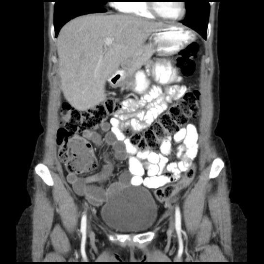 File:Atypical renal cyst (Radiopaedia 17536-17251 C 28).jpg