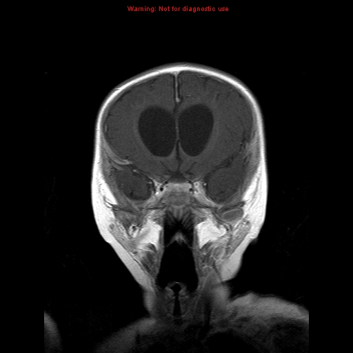File:Atypical teratoid rhabdoid tumor (Radiopaedia 10712-11183 Coronal T1 C+ 13).jpg