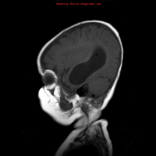 File:Atypical teratoid rhabdoid tumor (Radiopaedia 10712-11183 Sagittal T1 5).jpg