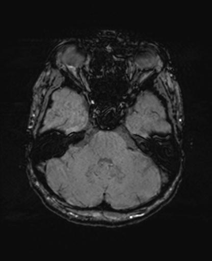 Autoimmune limbic encephalitis (Radiopaedia 30363-31005 SWI 21).jpg