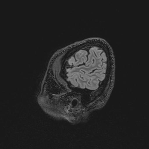 Autoimmune limbic encephalitis (Radiopaedia 30363-31005 Sagittal FLAIR 138).jpg