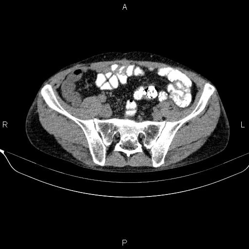 Autoimmune pancreatitis (Radiopaedia 84925-100431 Axial non-contrast 42).jpg