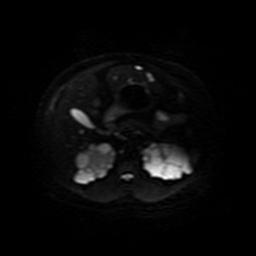 Autosomal dominant polycystic kidney disease (Radiopaedia 50259-55611 Axial DWI 17).jpg