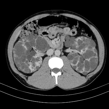 Autosomal dominant polycystic kidney disease (Radiopaedia 66349-75582 B 41).jpg