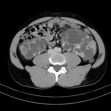 Autosomal dominant polycystic kidney disease (Radiopaedia 66349-75582 B 62).jpg