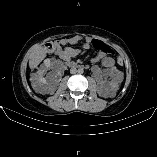 Autosomal dominant polycystic kidney disease (Radiopaedia 87830-104287 Axial non-contrast 27).jpg