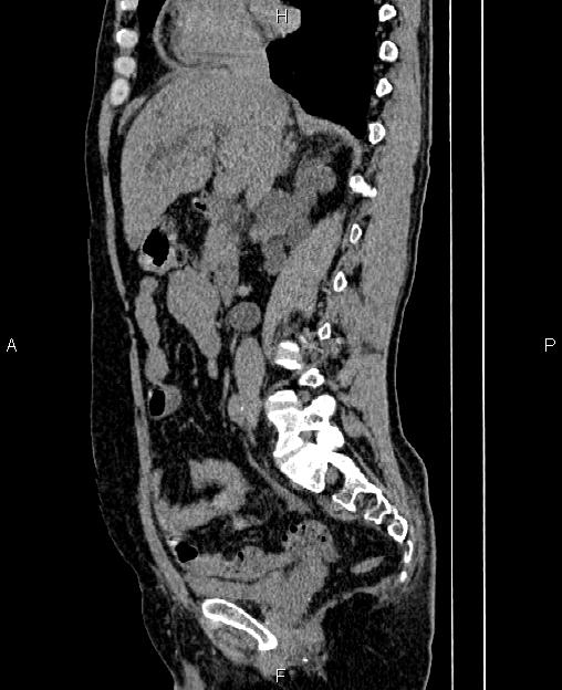 Autosomal dominant polycystic kidney disease (Radiopaedia 87830-104287 C 38).jpg