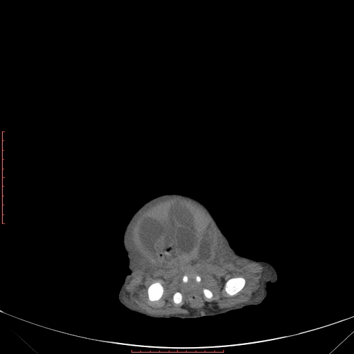 Autosomal recessive polycystic kidney disease associated with Caroli disease (Radiopaedia 61932-69984 Axial non-contrast 352).jpg