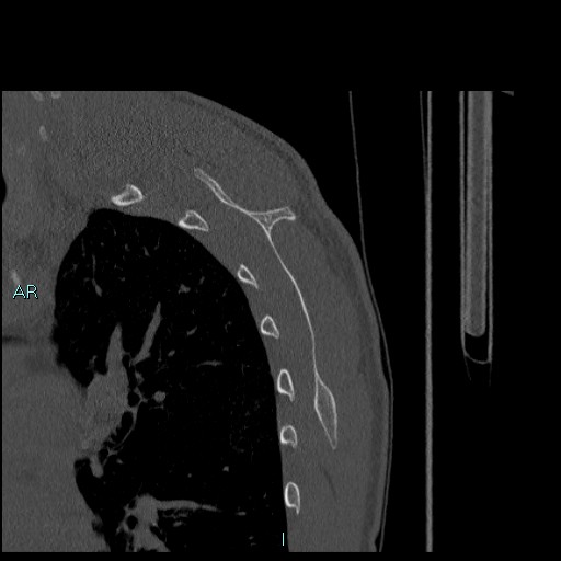 Avascular necrosis after fracture dislocations of the proximal humerus (Radiopaedia 88078-104655 Sagittal bone window 70).jpg