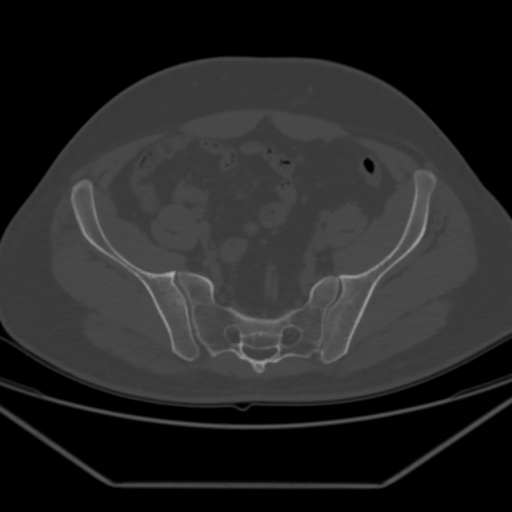 File:Avascular necrosis of the hip (Radiopaedia 61503-69467 Axial bone window 14).jpg