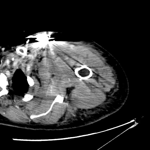 File:Axillary arterial pseudoaneurysm (Radiopaedia 24925-25195 A 2).jpg