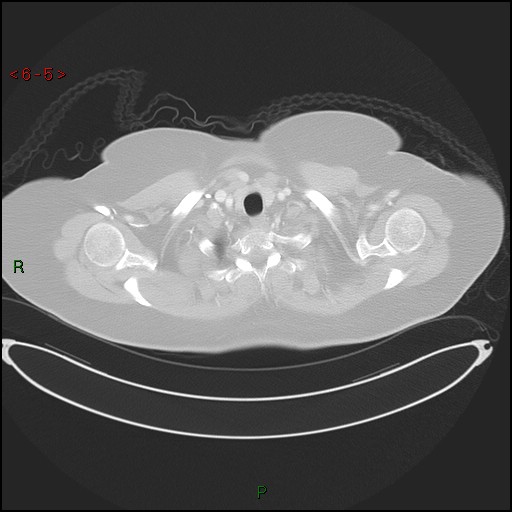 Azygos fissure and lobe (Radiopaedia 47620-52278 Axial lung window 5).jpg