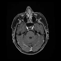 Balo concentric sclerosis (Radiopaedia 53875-59982 Axial LAVA C+ 83).jpg