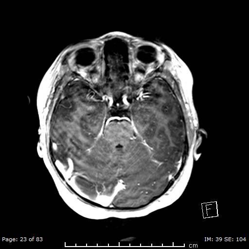 Balo concentric sclerosis (Radiopaedia 61637-69636 Axial T1 C+ 23).jpg