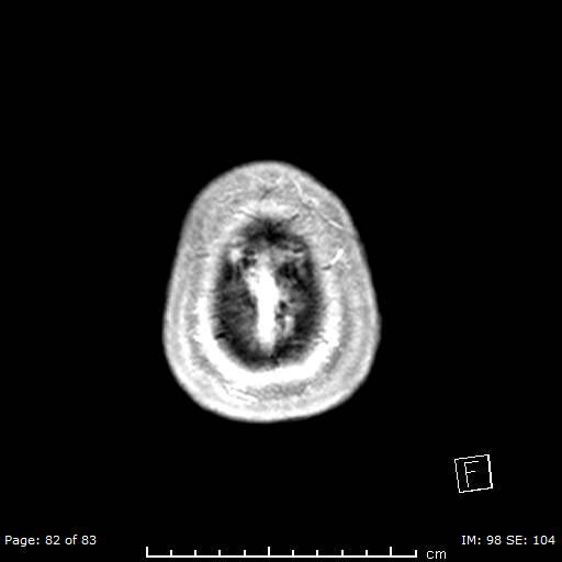 Balo concentric sclerosis (Radiopaedia 61637-69636 Axial T1 C+ 82).jpg