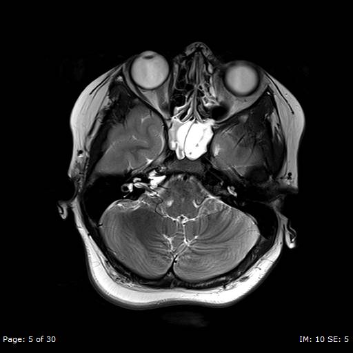 File:Balo concentric sclerosis (Radiopaedia 61637-69636 Axial T2 5).jpg