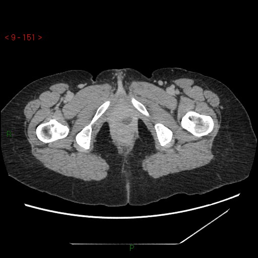File:Bartholin gland cyst (Radiopaedia 54904-61181 Axial C+ delayed 38).jpg