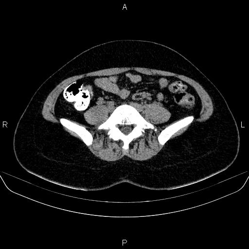 Bartholin gland cyst (Radiopaedia 62635-70930 Axial non-contrast 6).jpg