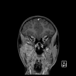 Base of skull rhabdomyosarcoma (Radiopaedia 32196-33142 I 25).jpg