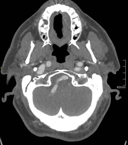 Basilar artery aneurysm (Radiopaedia 56261-62932 A 39).jpg