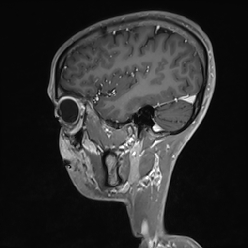 Basilar artery perforator aneurysm (Radiopaedia 82455-97733 G 37).jpg
