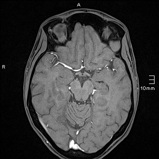 Basilar artery perforator aneurysm (Radiopaedia 82455-99523 F 58).jpg