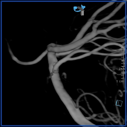 Basilar artery perforator aneurysm (Radiopaedia 82455-99524 3D Left VA 22).jpg