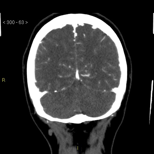 Basilar artery thrombosis (Radiopaedia 16260-15944 B 54).jpg