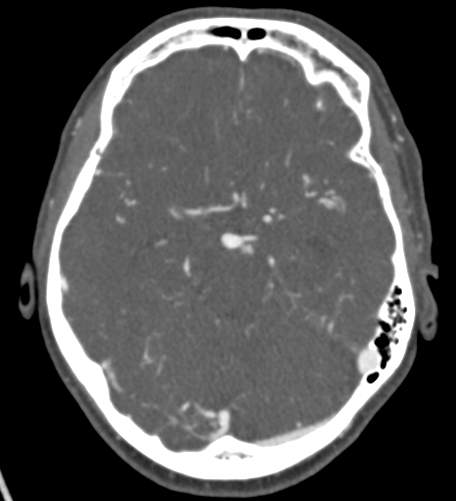 Basilar tip aneurysm with coiling (Radiopaedia 53912-60086 A 58).jpg