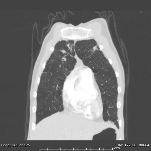 Behçet disease (Radiopaedia 44247-47889 Coronal lung window 53).jpg