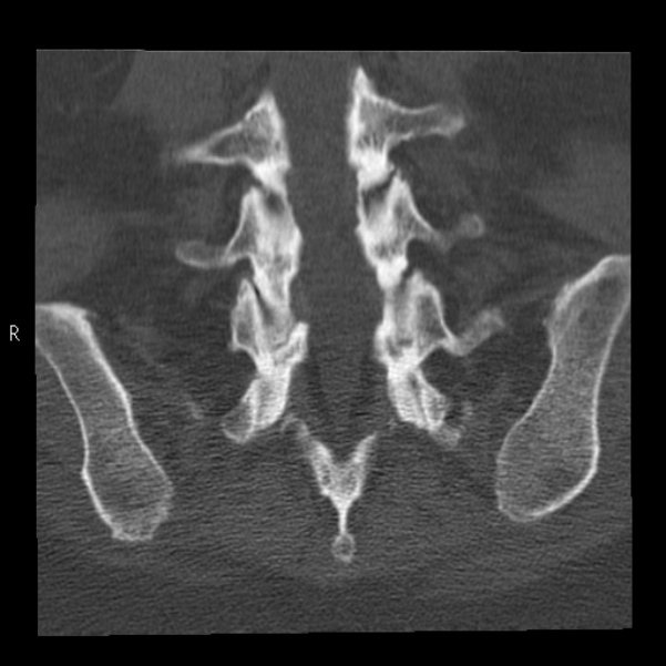 Bertolotti syndrome (Radiopaedia 24864-25128 Coronal bone window 35).jpg