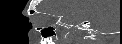 Bilateral Ectopic Infraorbital Nerves (Radiopaedia 49006-54084 Sagittal bone window 12).jpg