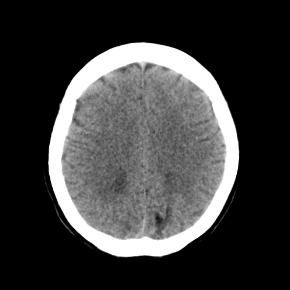File:Bilateral PCA territory infarction - different ages (Radiopaedia 46200-50591 Axial non-contrast 16).jpg