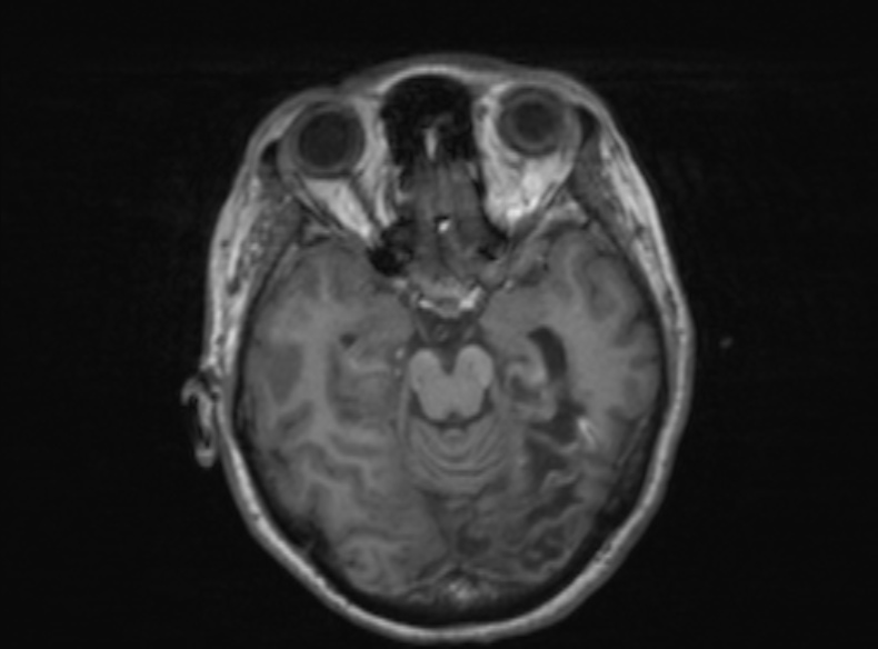 Bilateral PCA territory infarction - different ages (Radiopaedia 46200-51784 Axial T1 272).jpg