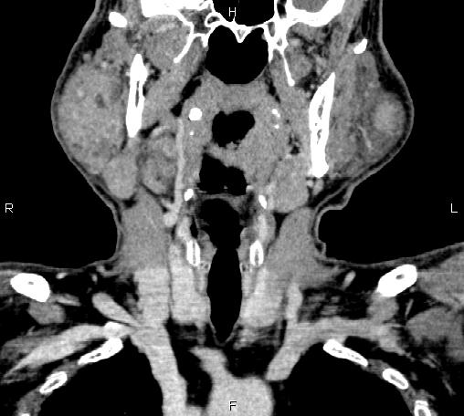 File:Bilateral Warthin tumors (Radiopaedia 84034-99263 C 21).jpg