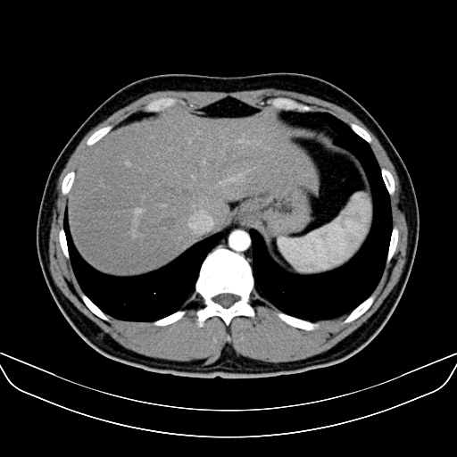 File:Bilateral accessory renal arteries with mild pelvi-ureteric junction (PUJ) obstruction (Radiopaedia 66357-75596 A 4).jpg