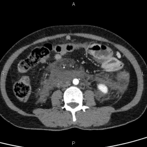 File:Bilateral adrenal gland hyperenhancement in pancreatitis (Radiopaedia 86642-102753 B 78).jpg