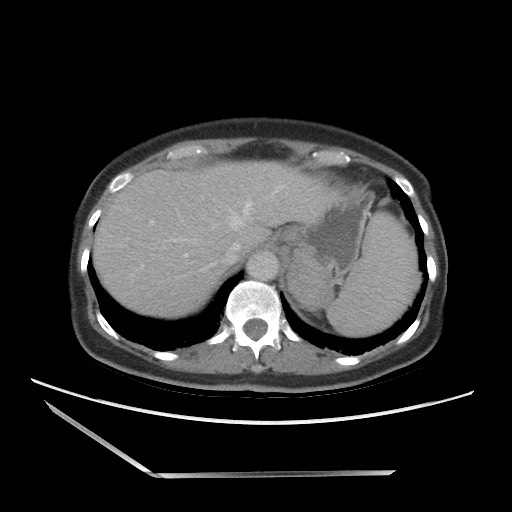 Bilateral adrenal granulocytic sarcomas (chloromas) (Radiopaedia 78375-91007 A 23).jpg