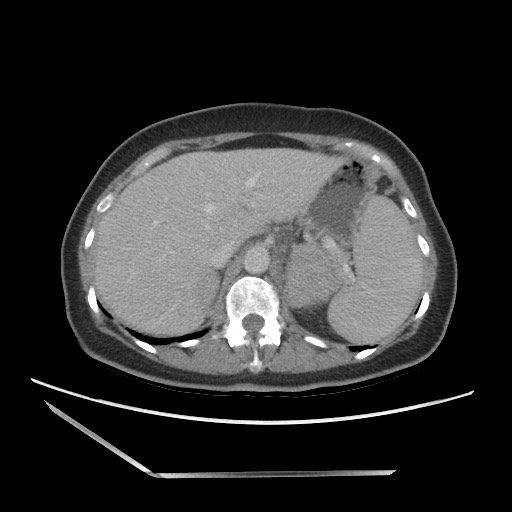 Bilateral adrenal granulocytic sarcomas (chloromas) (Radiopaedia 78375-91007 A 30).jpg