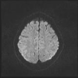 File:Bilateral basal ganglia and thalamic T1 hyperintensities (Radiopaedia 19764-19802 Axial DWI 34).jpg