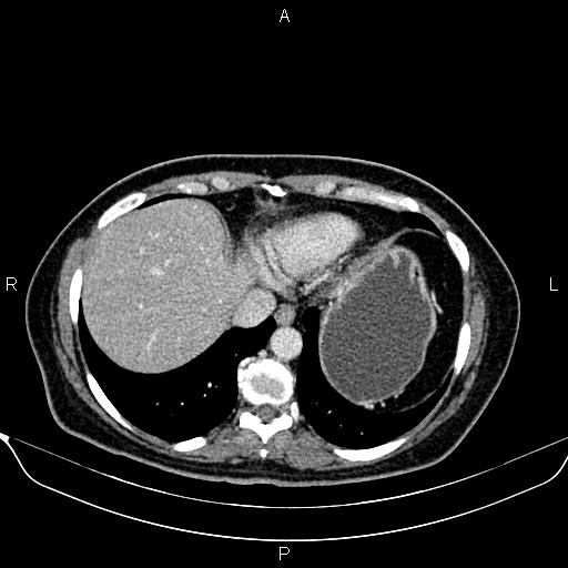 Bilateral benign adrenal adenomas (Radiopaedia 86912-103124 B 16).jpg