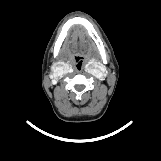 Bilateral carotid body tumors (Radiopaedia 52899-58827 A 17).jpg