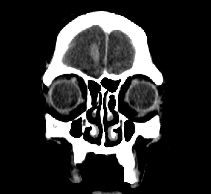 Bilateral ectopia lentis (Radiopaedia 89889-107013 Coronal non-contrast 27).jpg