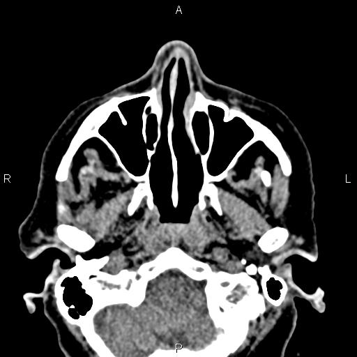 File:Bilateral enlargement of lacrimal glands - sarcoidosis (Radiopaedia 62627-70921 Axial non-contrast 12).jpg