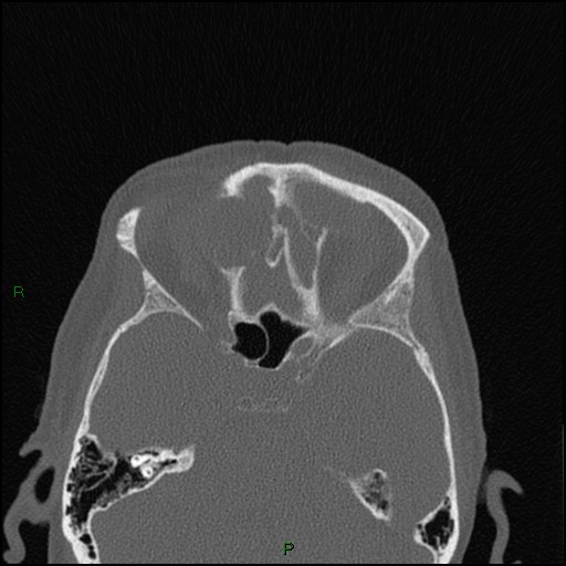 Bilateral frontal mucoceles (Radiopaedia 82352-96454 Axial bone window 124).jpg