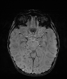 Bilateral mesial temporal polymicrogyria (Radiopaedia 76456-88181 Axial SWI 27).jpg