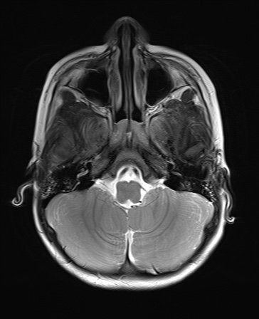 File:Bilateral mesial temporal polymicrogyria (Radiopaedia 76456-88181 Axial T2 4).jpg