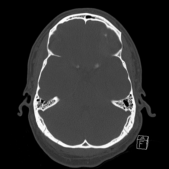 Bilateral occipital condyle fracture (type 2) (Radiopaedia 87675-104089 Axial bone window 43).jpg